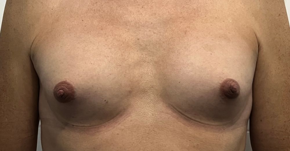 Trans women aged 59 2yrs on Hrt natural breast growth 