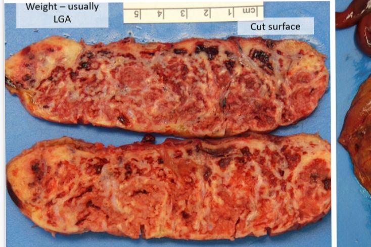 Placenta cut surface showing bands of fibrin. Gross photo.
