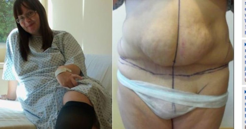 Mulher faz cirurgia para retirar barriga e acorda com “pênis”