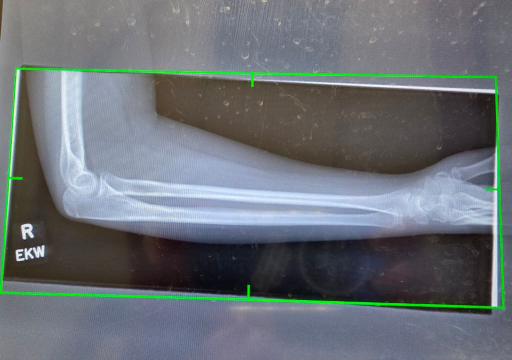 X-ray of teenager's right arm including elbow and wrist.