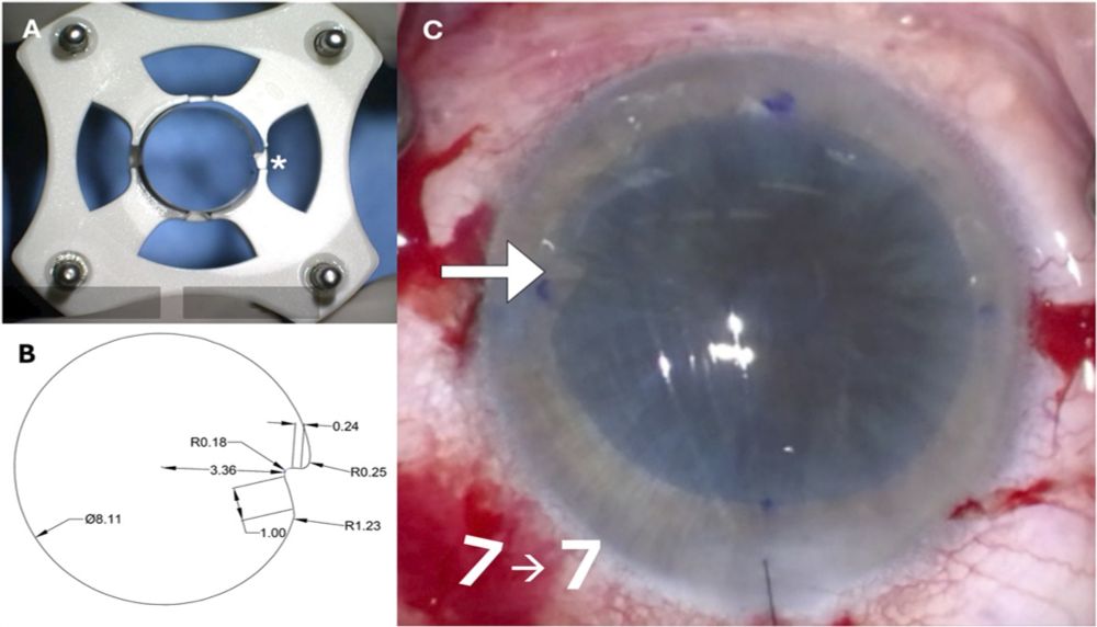 Novel Trephine for Descemet Membrane Endothelial... : Cornea