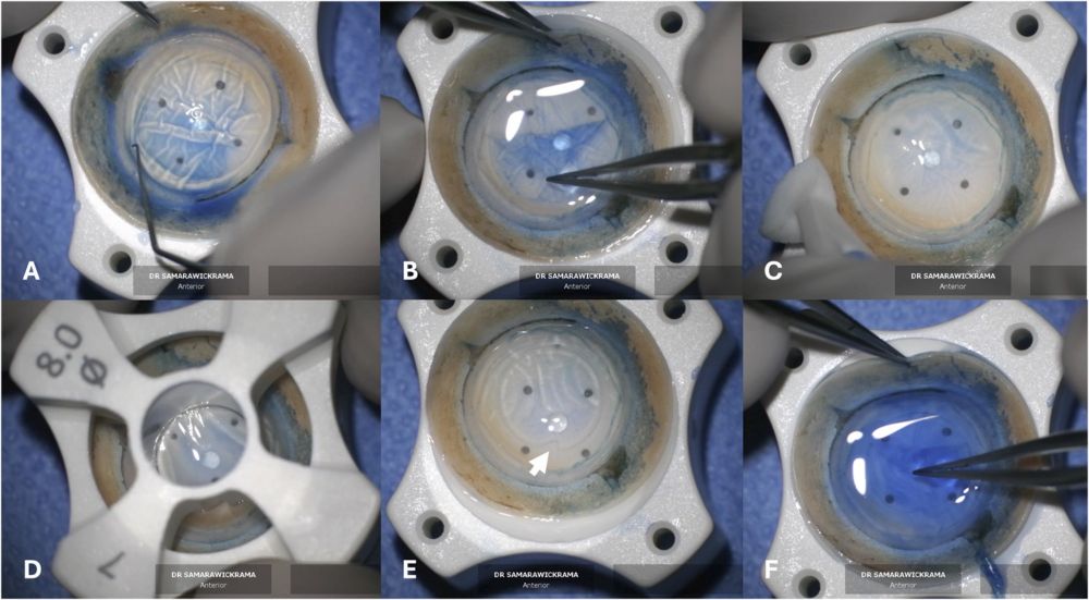 Breakthrough in Corneal Surgery Makes the Procedure Quicker & Safer  - Dr. Chameen Sams