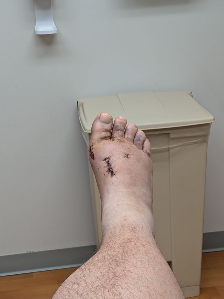 Post surgery feet with stitches and bruising