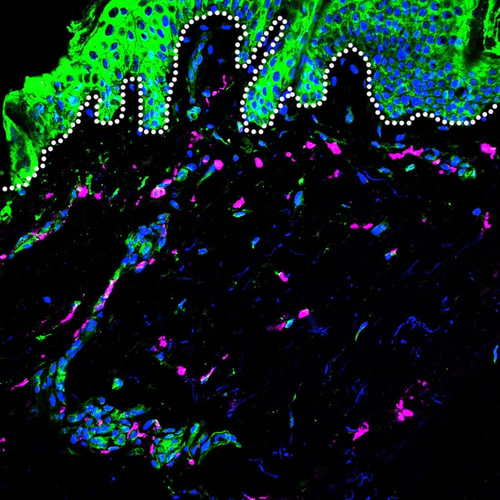 A skin section from an individual with European ancestry showing infected skin cells (with blue nuclei) and macrophages (magenta) around the epidermal-dermal junction (white dotted line) 24 hours after exposure to dengue virus (green).
CREDIT: Priscila Da Silva Castanha
