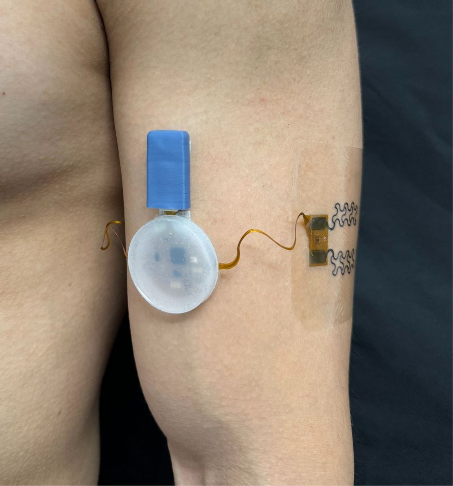 Wireless, arm-worn bioimpedance sensor for mobile, continuous assessment of whole-body hydration during everyday activities. 
CREDIT: Matija Jankovic, UT Austin
