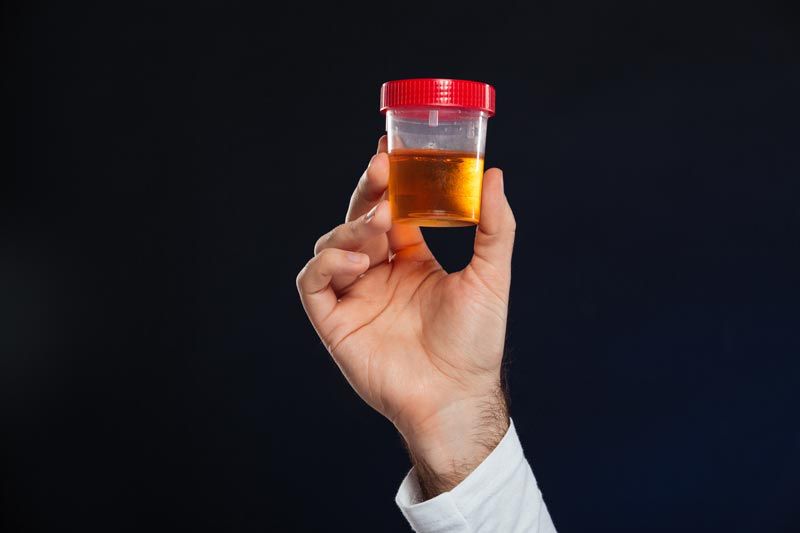 A photo of what appears to be a human hand holding what appears to be a sample cup of urine, from a patient who clearly hasn't had enough water to drink lately.