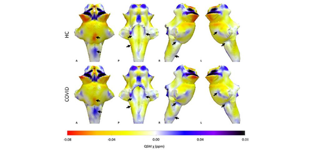 Ultra-powered MRI scans show damage to brain’s ‘control centre’ is behind long-lasting Covid-19 symptoms