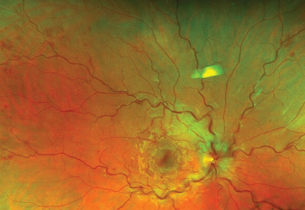 Eye problems give clues to systemic impact of COVID-19