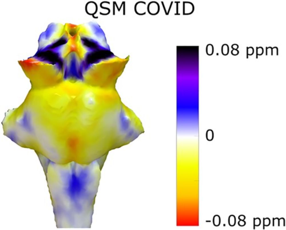 Quantitative susceptibility mapping at 7 T in COVID-19: brainstem effects and outcome associations