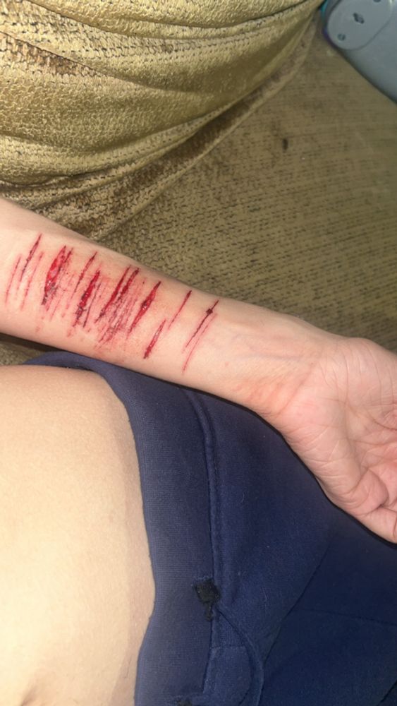 A white arm with mostly some little cuts but a few cleaned up, deep, red cuts, rested against a body and sweatpants. 