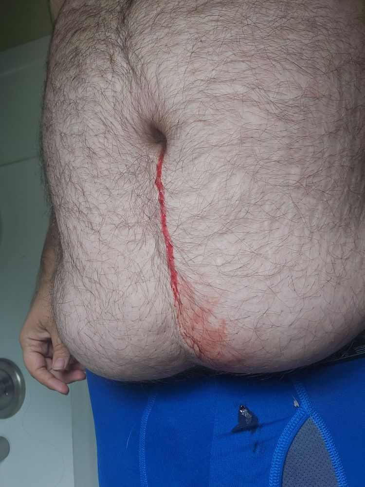 Blood coming from belly button