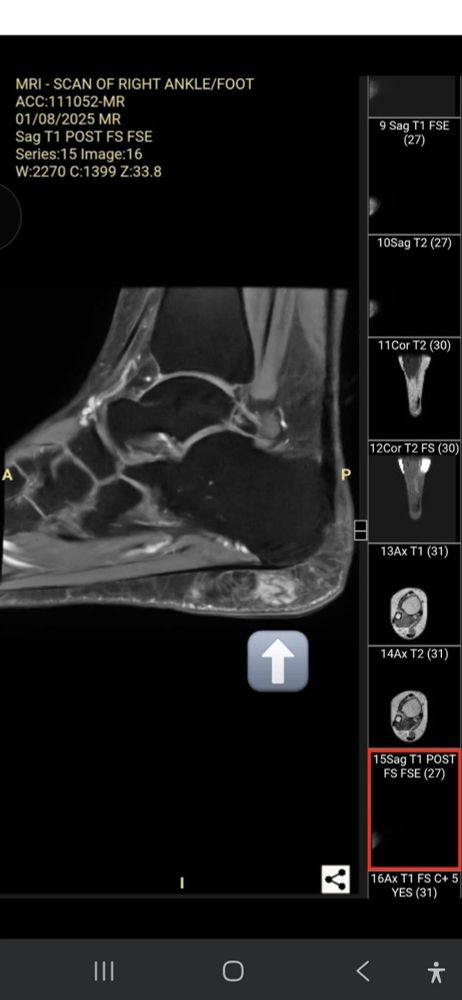 MRI image of foot with arrow pointing to area of concern 