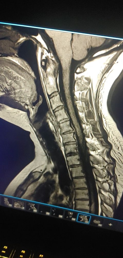 An MRI image of a c spine shows bulging discs, disc degeneration, bone spurs, a loss of natural curve, and impingement of the spinal cord. 