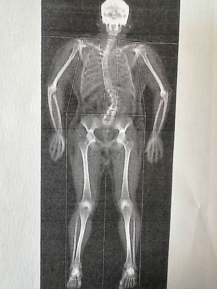 jc's skeleton via a bone density scan, most notably characterised by an alarming degree of scoliosis and concomitant ribs that don't make a great deal of sense visually, and also a skull that looks like it ought to have googly eyes pasted on to it, because skulls are absurd