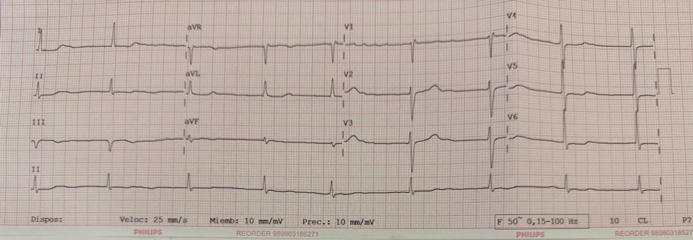 Picture shows a printed ecg. 