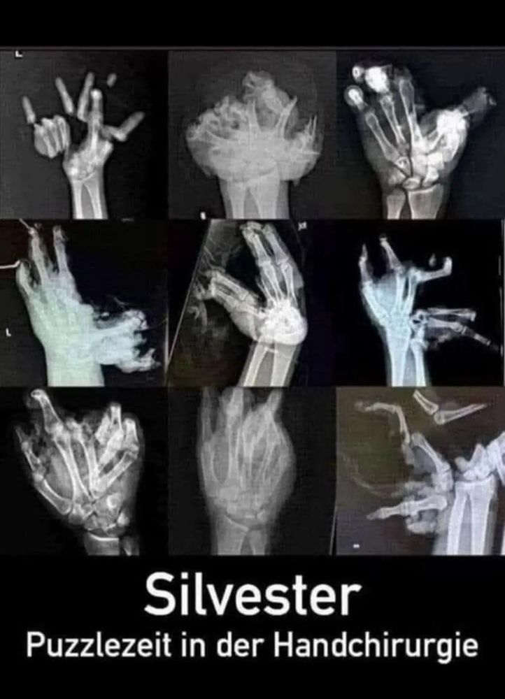 Collage mit Röntgenbilder von Händen, die durch Silvesterböller sehr zerstört sind