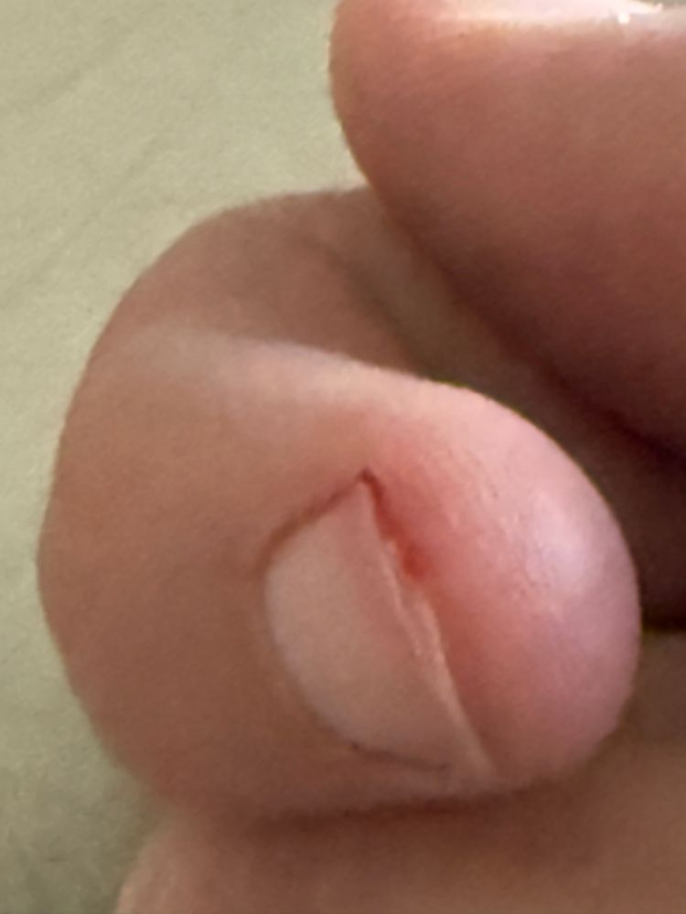 Finger with paper cut under nail
