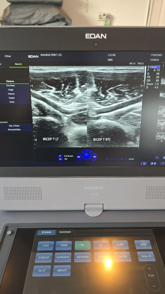 Ultrasound laptop with images of biceps tendon.
