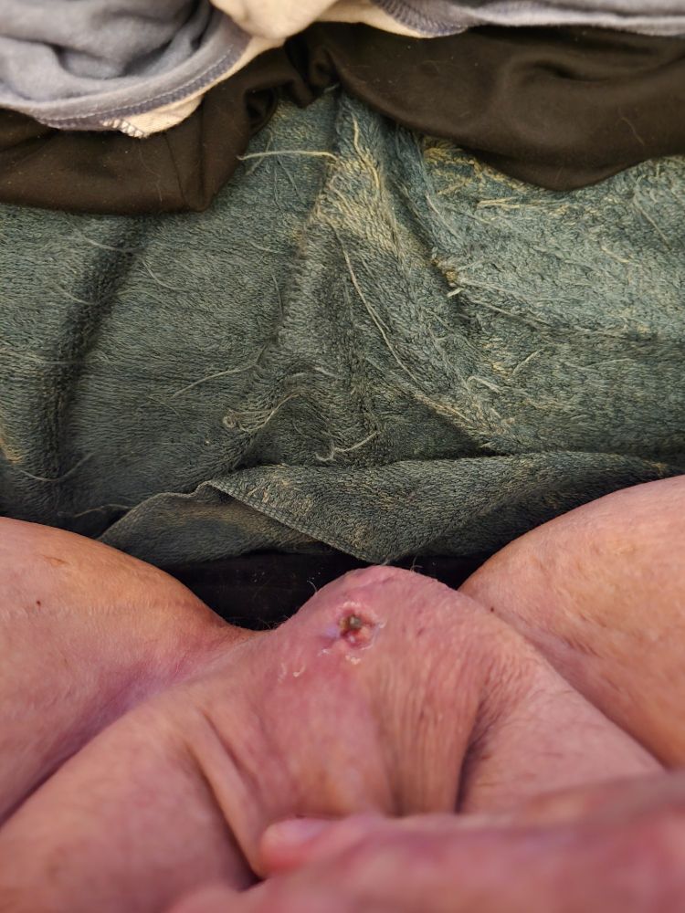 Four weeks after surgery