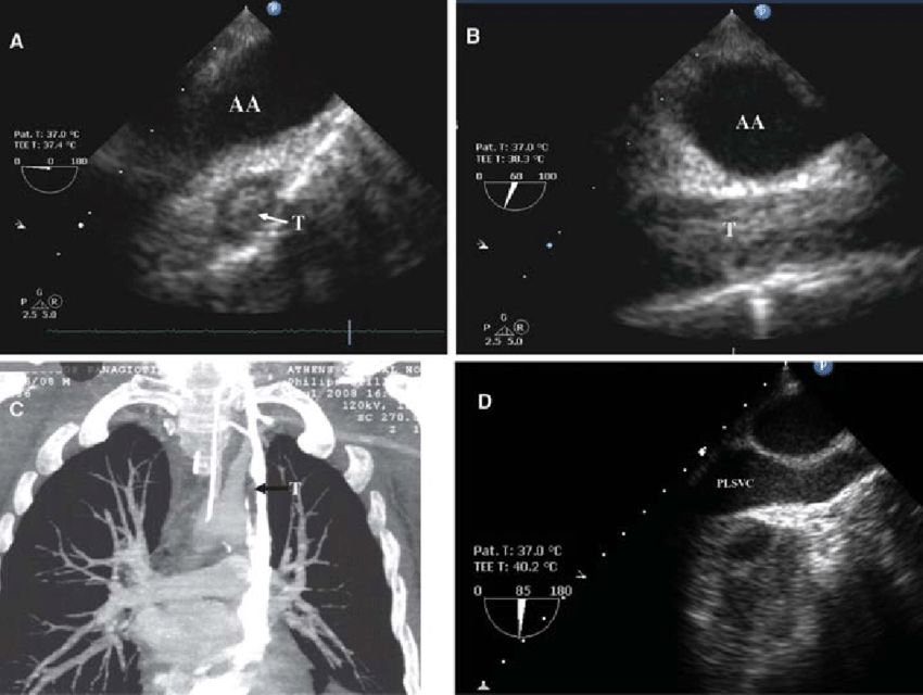 Image source: https://www.researchgate.net/publication/24146723/figure/fig4/AS:669192080609282@1536559233265/A-and-B-PLSVC-thrombosis-arrow-in-long-and-short-axis-view-respectively-C-CT.png