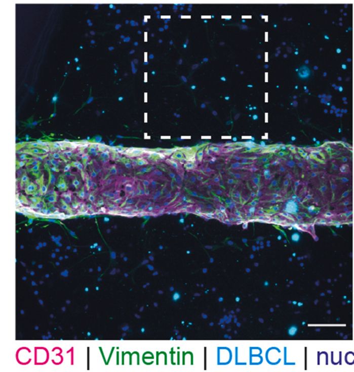 Immunofluorescence picture of the lymphoma-on-chip including staining of lymphatic vesell cells (red, CD31), primary fibroblasts (green, vimentin), and lymphoma cells (blue, "DLBCL").