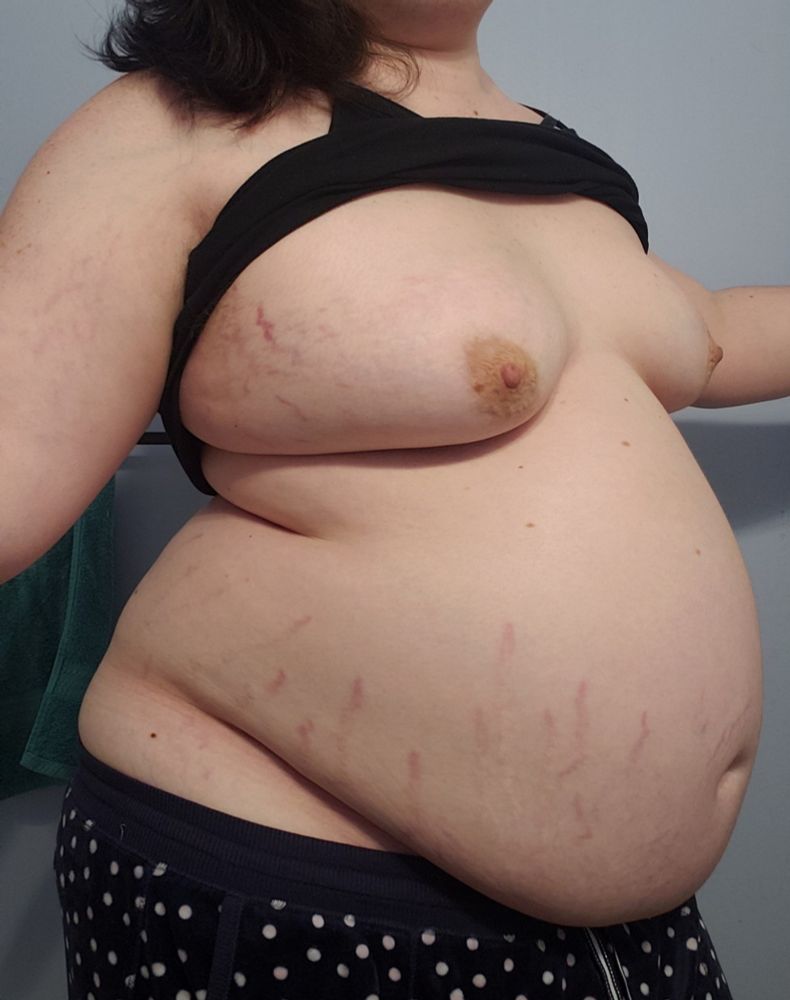 A visibly obese brunette takes up the entire frame. Her belly is hanging over her pajamas. Her tits are big, she is covered in stretch marks on her arms, breasts, and belly. 