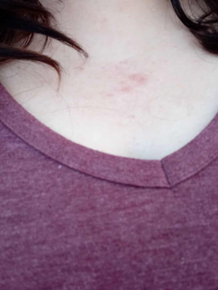 Foto de mi pecho con sarpullido. 