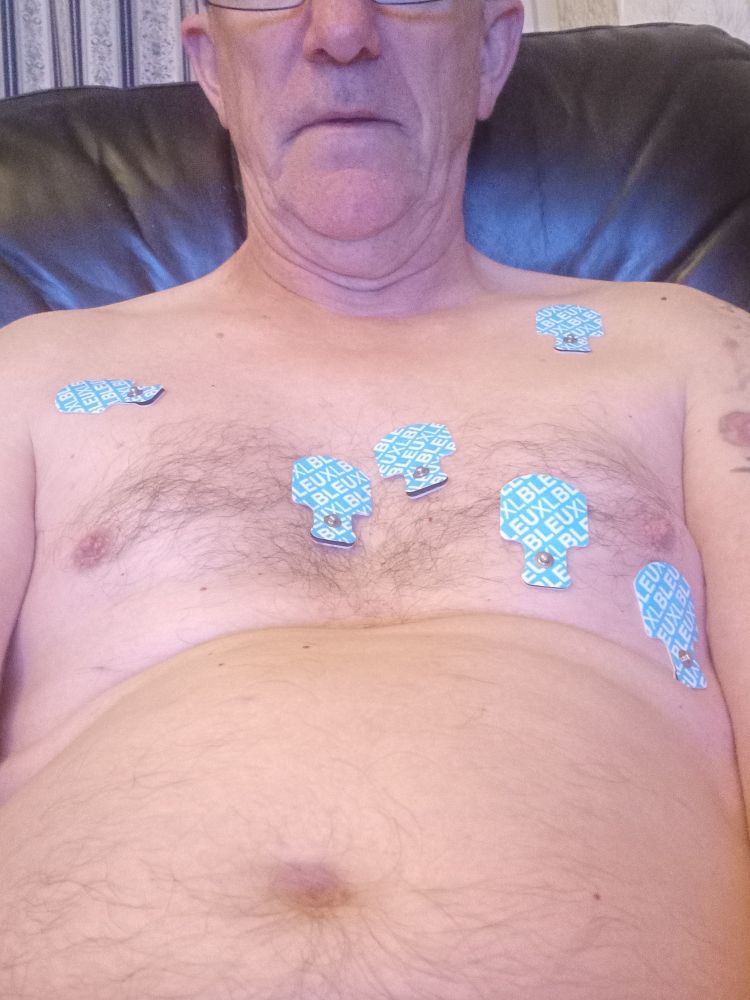 How yesterday was spent. Upper body covered in ECG pads