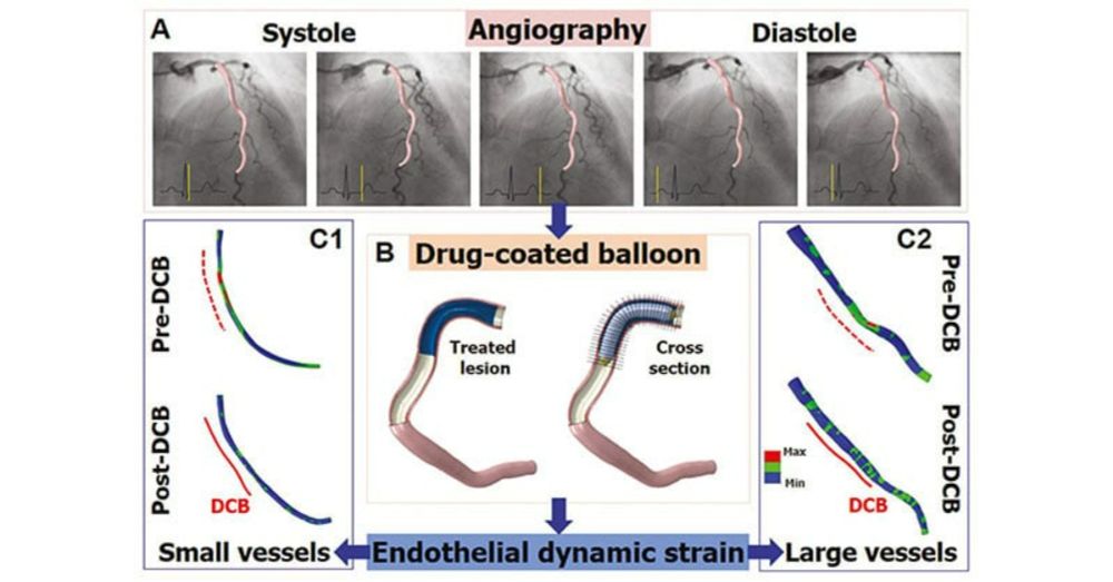 Angiography-Based Computational Modeling for In Vivo Assessment of Endothelial Dynamic Strain in Coronary Arteries with De Novo Lesions: Comparison of Treatment Effects of Drug-Coated Balloons Between...