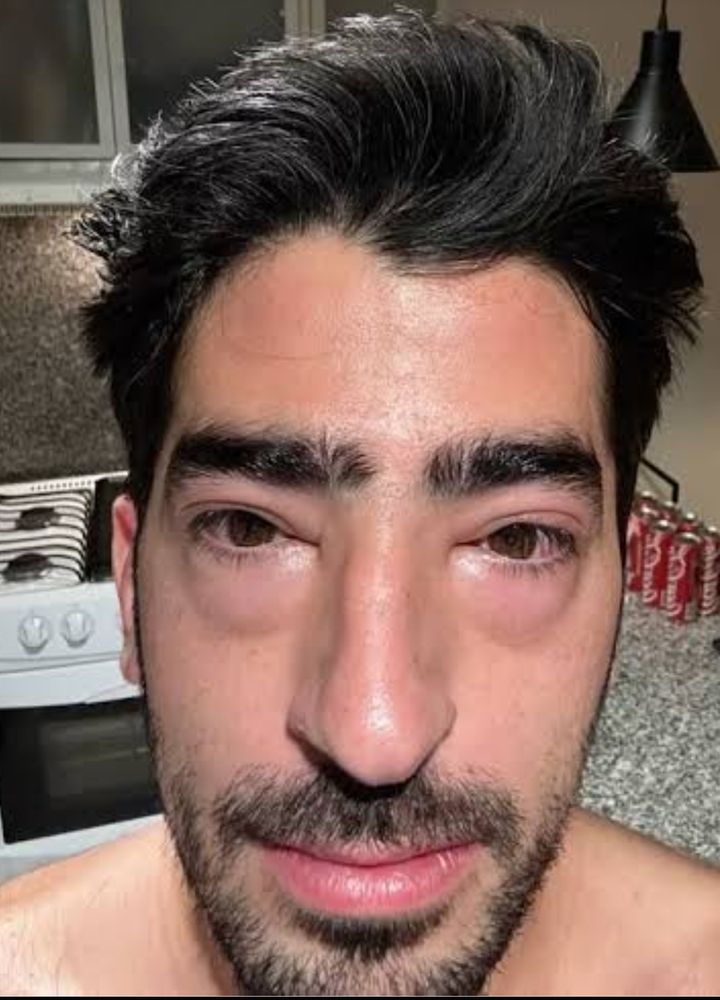 jezzini con la reacción alérgica