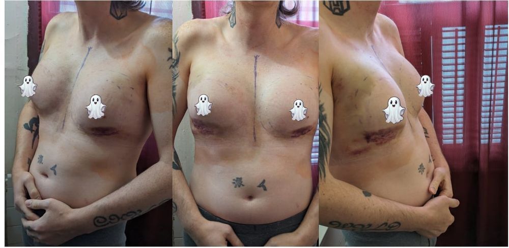 A three picture collage showing a trans woman's uncovered, but still censored torso. Pictures one and three are taken at slight angles while the middle picture is a straight-on shot. Her nipples are covered by cartoon ghosts