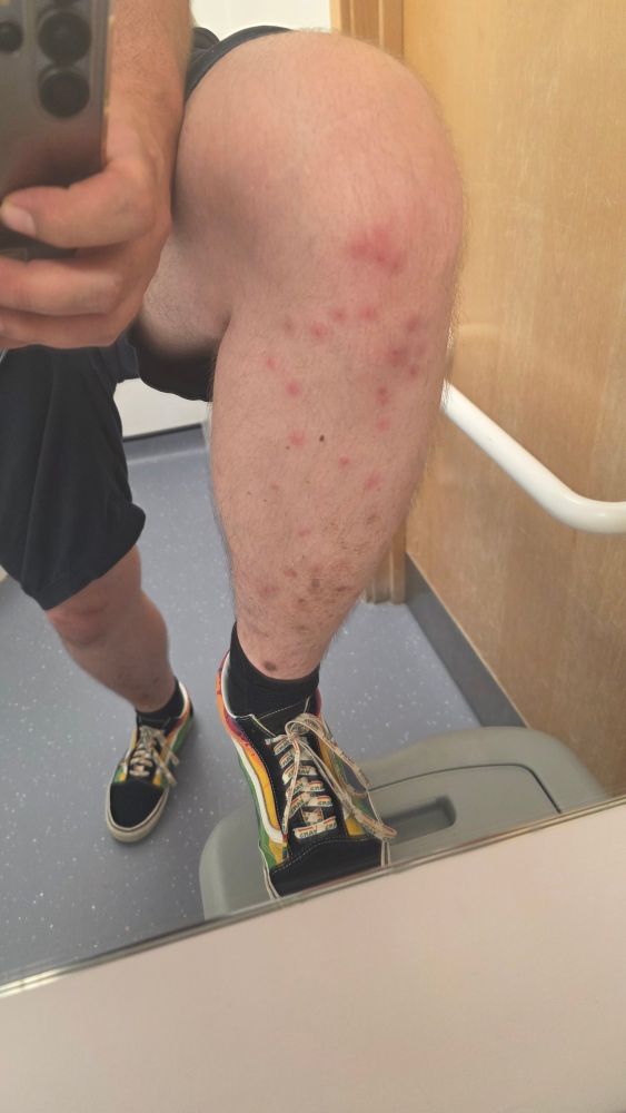 A big, white, hairy leg belonging to a big, white, hairy person. It is absolutely riddled with insect bites. Seriously, there are like 30 visible bites. It's kinda gross, actually!