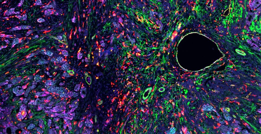 This is a rare type of tumor called Sertoli-Leydig tumor, which makes up fewer than 0.5% of all ovarian tumors. Though rare, Sertoli-Leydig tumors can cause significant hormonal imbalances. All tumors are heterogeneous. That means they’re made up of lots of different types of cells all working together. This colorful image shows the tumor tissue at the single-cell level. Each color highlights a different cell type within the tumor’s complex microenvironment.

Cutting-edge imaging tools like single-cell sequencing can help scientists visualize and understand how cells work together (or against each other) in a tumor environment.

The blue ovals are the nuclei of individual cells. Yellow highlights the endothelial cells that form blood vessels, while magenta and cyan mark different types of epithelial tumor cells. The green strands represent myofibroblasts and perivascular cells—supporting cells often involved in tissue remodeling. Orange spots show macrophages, a type of immune cell that helps clear debris, and red marks antigen-presenting cells, which help alert the immune system to potential threats.