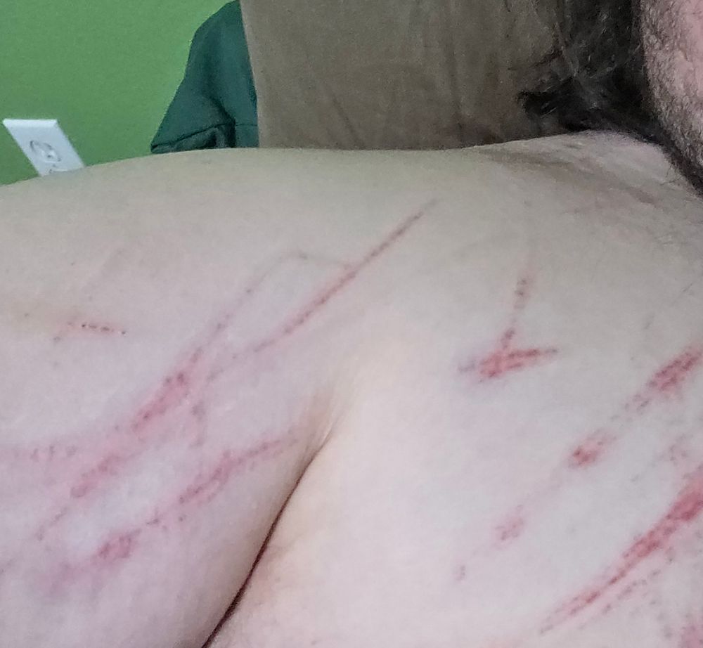 Pressure bruising from a dog's nails around the chest and upper arm.