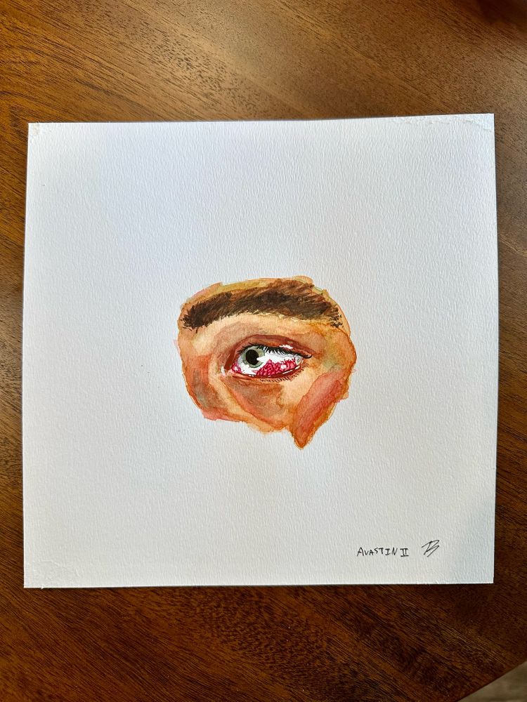A watercolor and ink painting of Ty’s eye, which had blood in the sclera and visible irritated blood vessels. The painting is titled Avastin 2