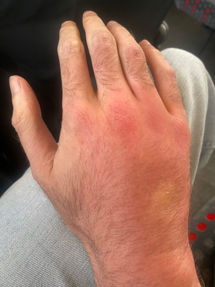 My swollen hand, which is full of pus. 