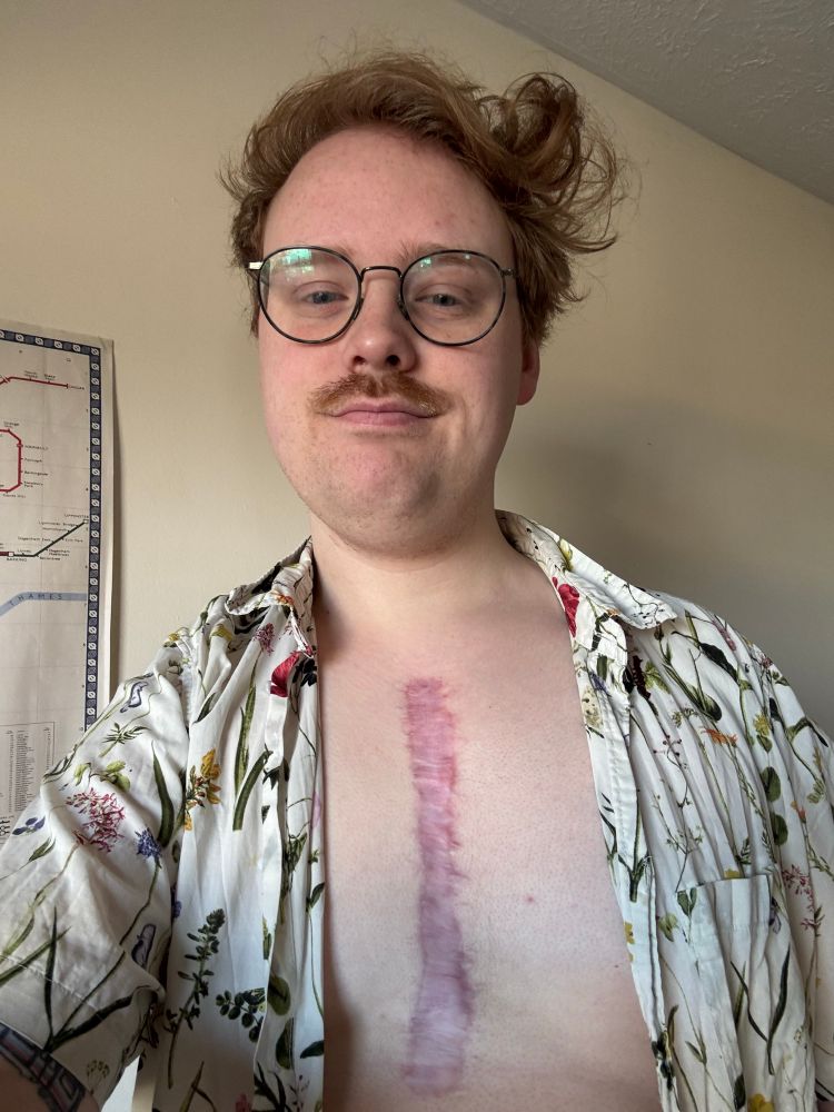 March 2025 floral shirt for spring ground breaking with large surgery scar across chest 