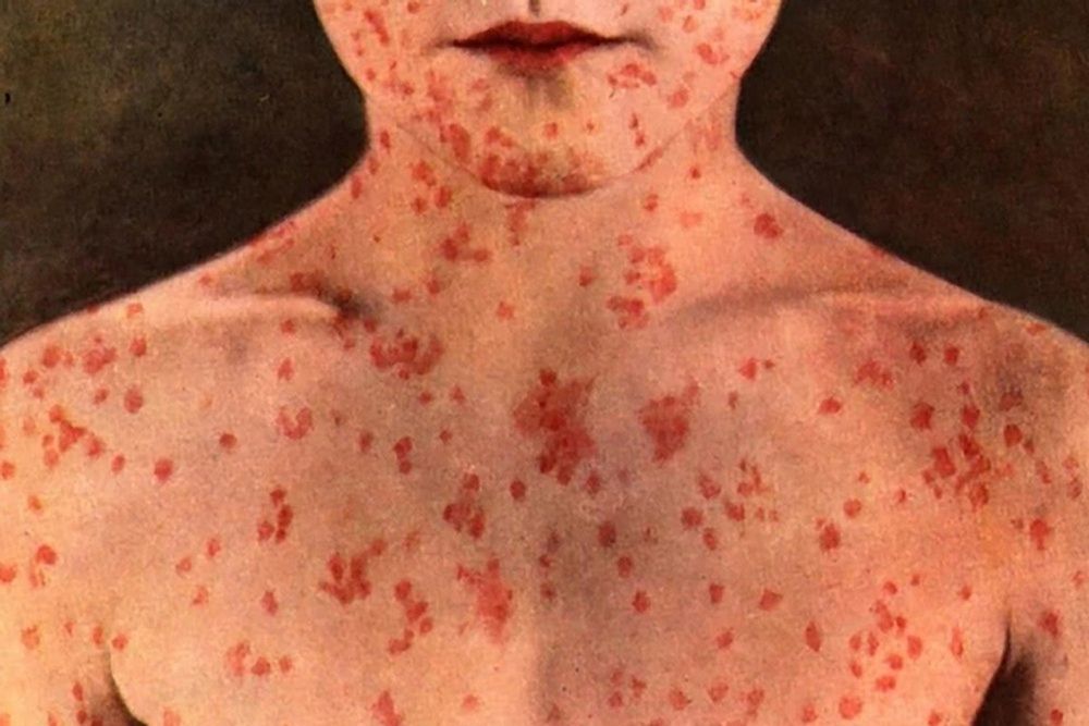 The province reported Friday that there are now 1,656 measles cases in Alberta.