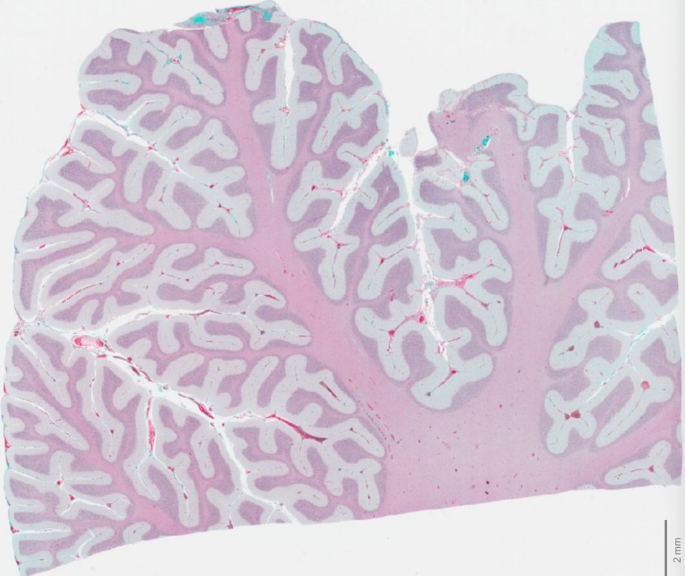 This image of a paediatric brain shows collagen (in green), which is a key part of the ECM, with healthy brain (in pink and purple). Researchers hope that targeting components like this that surround a tumour could open new pathways for immunotherapies to better reach and attack cancers. 