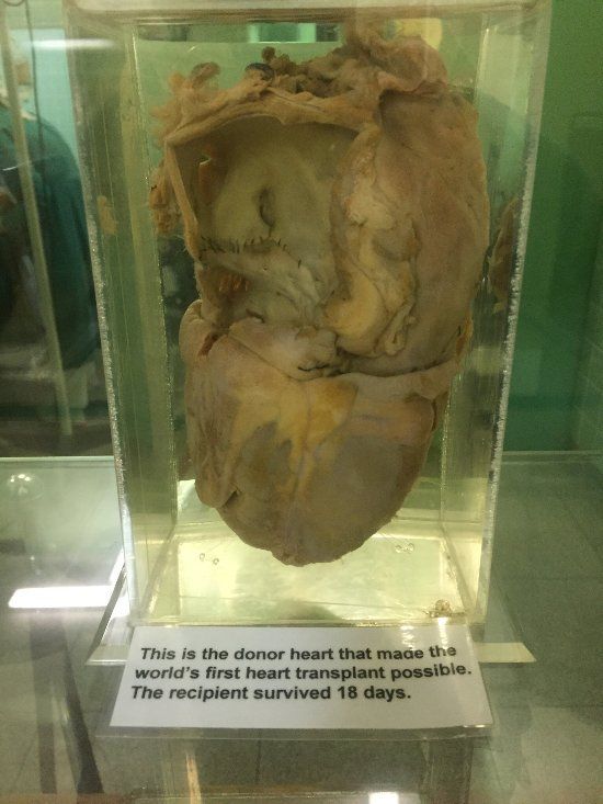 This is the donor heart that made the world's first heart transplant possible.