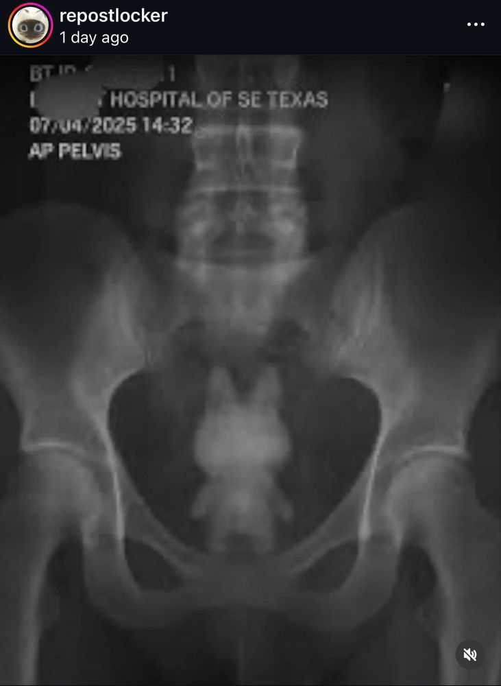an x-ray of a human pelvis that shows the outline of what looks like a labubu doll lodged inside the body 