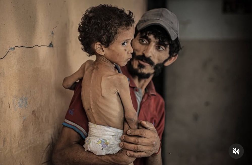Photos d’un enfant en malnutrition à Gaza (Heidi Levine)