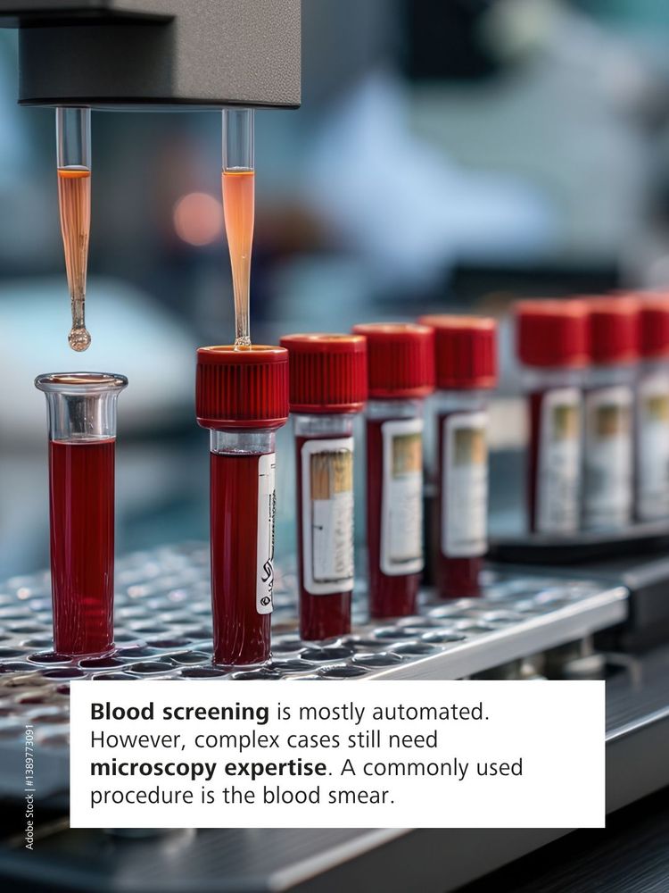 Automated machine transfers blood samples into test tubes for screening; text explains the role of microscopy expertise in complex cases and describes the blood smear procedure.