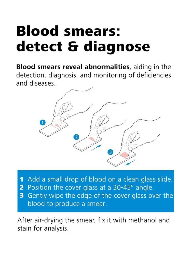 Step-by-step instructions with illustrations showing how to prepare a blood smear on a glass slide for analysis and diagnosis