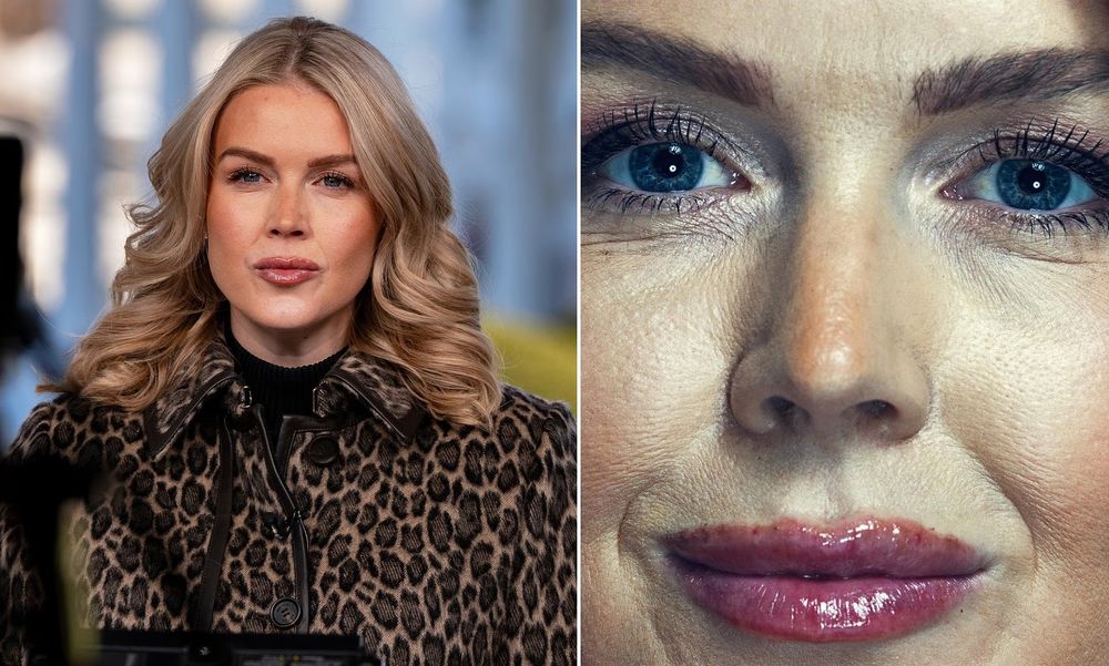 Montagem com duas fotos de uma mulher loira. Uma de longe e outra de muito perto mostrando linhas de expressão e marcas de injeções de preenchimento labial. 