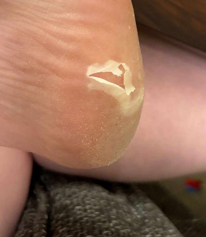 A close up of Peachy’s heel. The skin is broken and peeling to reveal soft pink skin underneath. 