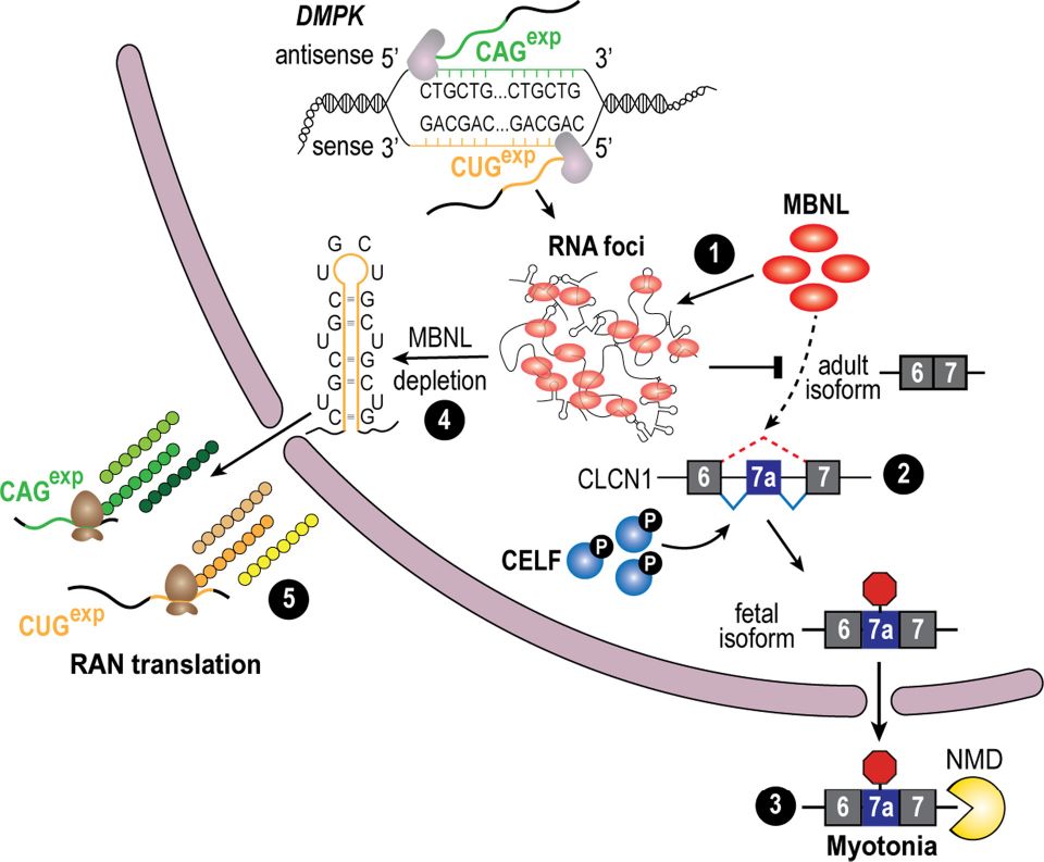 RNA gain-of-function pathomechanism in DM1. Bidirec-
tional transcription of DM1 DMPK produces sense CUGexp RNAs
that bind MBNL proteins (red ovals), which undergo RNA–RNA,
RNA–protein, and protein–protein multivalent interactions to form
RNA foci or condensates (1). In contrast to sense transcription, anti-
sense transcription yields very low-abundance RNAs with/without
CAGexp repeats (Gudde et al. 2017). MBNL sequestration in these
foci together with phosphorylated CELF (blue sphere with black P)
overexpression promotes fetal splicing patterns for target RNAs in
adult tissues, and in DM1 skeletal muscle, exon 7A inclusion in
CLCN1 mRNA (fetal isoform) (2) results in nonsense-mediated decay
(NMD), CLCN1 loss, and myotonia (3). Somatic CTG expansions result
in extremely long CUGexp tracts that deplete MBNL (4) from the dilute
nucleoplasmic pool, leading to release of intact or fragmented mutant
DMPK mRNAs into the cytoplasm where they undergo RAN transla-
tion, giving rise to toxic RAN proteins (green and brown/yellow beads)
(5). Mutant DMPK antisense transcripts may be exported into the cy-
toplasm at a low level, resulting in RAN translation of polyGln (Zu et al.
2011), and possibly polySer and polyAla, proteins.