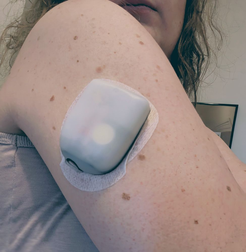 Une pompe à insuline Omnipod posée sur mon bras, sans coque.