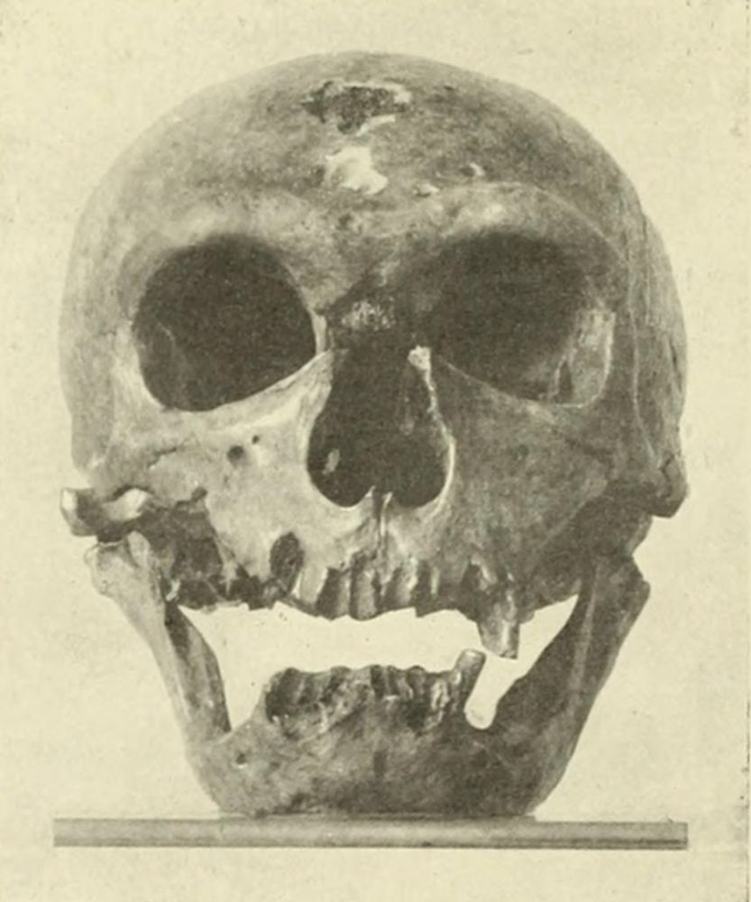 A frontal black-and-white photograph of the same Neanderthal skull. The orbits are large and round, and the nasal opening is broad. The brow ridges are thick and prominent. The maxilla and mandible are both incomplete, with several missing teeth and broken portions along the lower jaw.