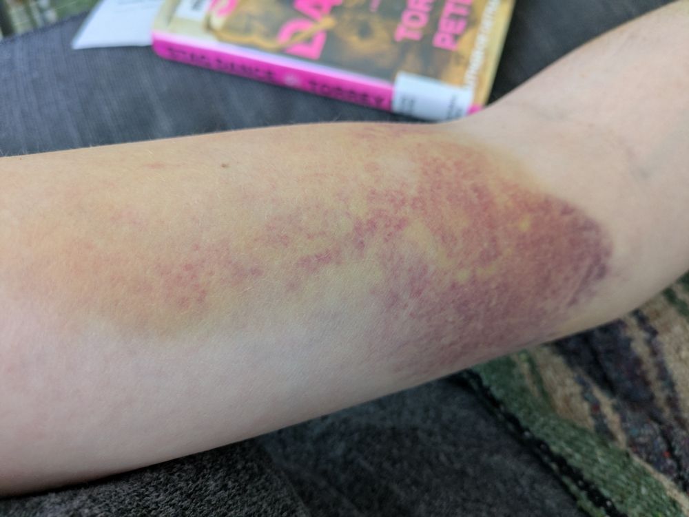 a photograph of a beautiful bruise